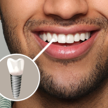 man with perfect teeth smiling, dental implant