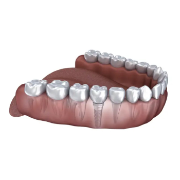 A 3d image of a dental implant in a patient's mouth.