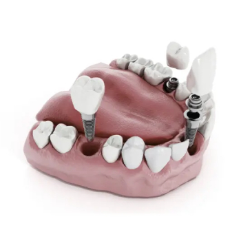 A 3d model of a tooth with dental implants.