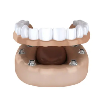 A model of a dental implant.