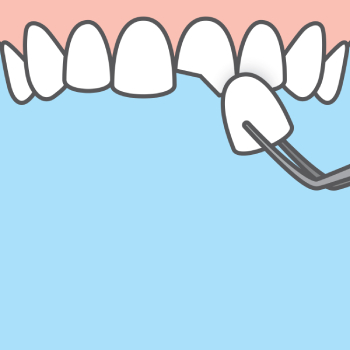 porcelain veneers for cracked teeth