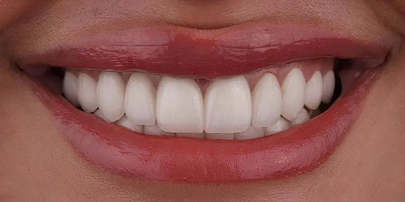 Dental Treatment After Results Patient smile after dental treatment