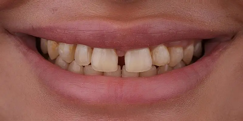 Teeth gap correction results