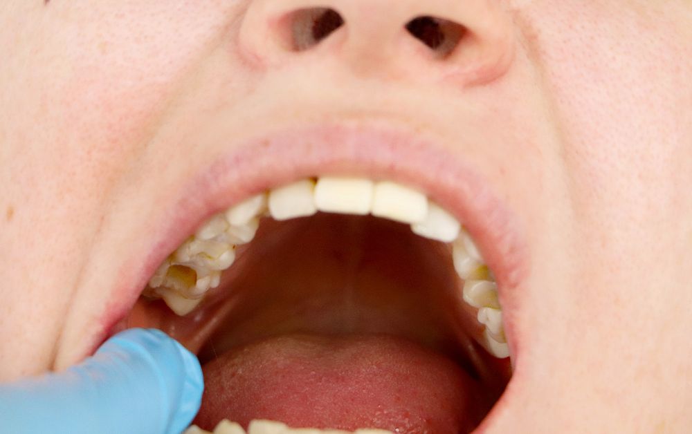 Inflamed bleeding gums caused by tobacco use